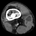 Thumbnail of Computed tomography scan of the right lower extremity of a 21-year-old patient, showing abscess formation adjacent to nonunion of a right femur fracture.