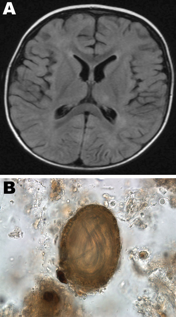 A) Magnetic resonance imaging (MRI) of the brain of a 14-month-old child with Baylisascariasis encephalitis. B) Baylisascarasis procyonis embryonated egg found in wet preparation of raccoon feces; original magnification ×100.