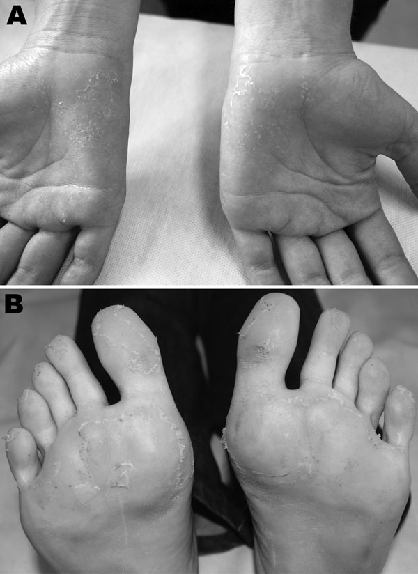 Clinical features exhibited by patient with chikungunya, Brazil 2010. A) Desquamation of palms after maculopapular rash, 33 days after symptom onset. B) Desquamation of soles after maculopapular rash, 33 days after symptom onset.