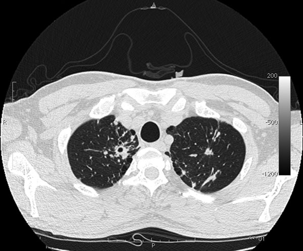 Computed tomography image of chest of patient with tuberculosis after anti–hepatitis C virus therapy. A parenchymal distortion 32 mm in diameter is shown in the upper right lung with initial central excavation 10 mm in diameter (horizontal arrow). Similar lesions 8 mm in diameter without central excavation are shown in the upper left lung (vertical arrow).