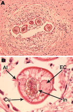 Thumbnail of Baylisascaris procyonis infection in the frontal cerebral lobe white matter. A) Larval nematode seen in multiple transverse sections, surrounded by mild chronic inflammation and reactive changes. Hematoxylin and eosin stain; original magnification ×10. B) Morphologic features of the larvae included maximum diameter of 65 μm; thin, striated cuticle (Cu); single paired lateral alae (Al); and paired excretory columns (EC) that were smaller in diameter than the central intestine (In). H