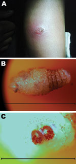 Thumbnail of A) Lateral aspect of the upper arm of a 26-year-old woman showing cutaneous myiasis and an erythematous lesion 2.5 cm in diameter, Canada. B) Cordylobia rodhaini larva (length ≈1 cm) isolated from the erythematous lesion. Scale bar = 10 mm. C) Characteristic posterior spiracles of a C. rodhaini larva. Scale bar = 3 mm.