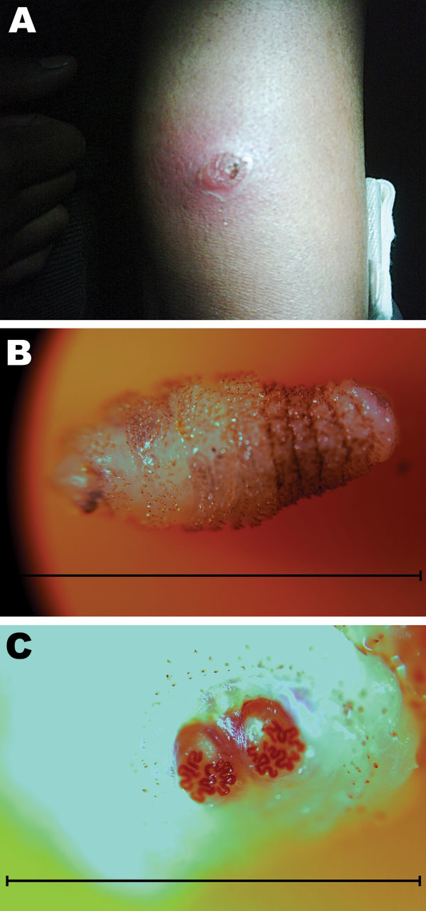 A) Lateral aspect of the upper arm of a 26-year-old woman showing cutaneous myiasis and an erythematous lesion 2.5 cm in diameter, Canada. B) Cordylobia rodhaini larva (length ≈1 cm) isolated from the erythematous lesion. Scale bar = 10 mm. C) Characteristic posterior spiracles of a C. rodhaini larva. Scale bar = 3 mm.