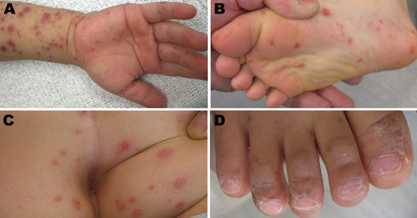 Typical clinical manifestations of hand, foot, and mouth disease associated with coxsackievirus CVA6 in Shizuoka, Japan, June–July, 2011. A) Hand and arm of a 2.5-year-old boy; B) foot and C) buttocks of a 6-year-old boy; D) nail matrix of a 20-month old boy.
