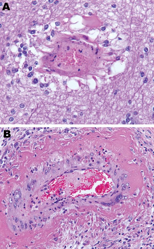Brain vasculitis in horse experimentally infected with Hendra virus, Australia. A) Parenchyma and B) ovary of horse 2. Original magnification ×200.