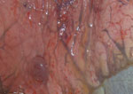 Thumbnail of Dilation of lymphatic vessels and ventral lung lobe margins of horse 3 experimentally infected with Hendra virus, Australia. Original magnification ×10.