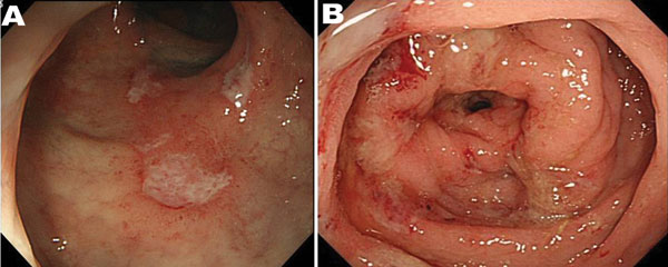 Endoscopic features of amebic colitis, Japan, 2003–2009. A) Colonoscopy showing ulcers in the rectum. B) Colonoscopy showing multiple erosions with exudates surrounded by edematous mucosa in the sigmoid colon.
