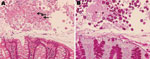 Thumbnail of Histologic analysis of amebic colitis, Japan, 2003–2009. A) Trophozoites of Entamoeba histolytica ingesting erythrocytes (arrows) (hematoxylin and eosin stain). B) Numerous amebic trophozoites on the mucosal surface (periodic acid–Schiff stain). Original magnification ×200.