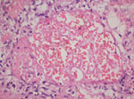 Thumbnail of Renal biopsy sample showing patchy cortical necrosis, hematoxylin and eosin staining, Ahmedabad, India, 2010–2011 Original magnification ×400.