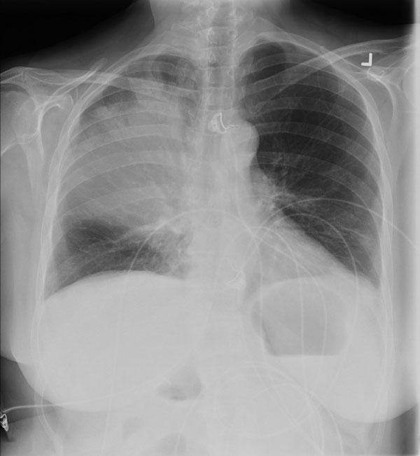 Chest radiograph demonstrating right-upper lobe consolidation in a 67-year-old woman with Legionella pneumophila serotype 1 pneumonia.