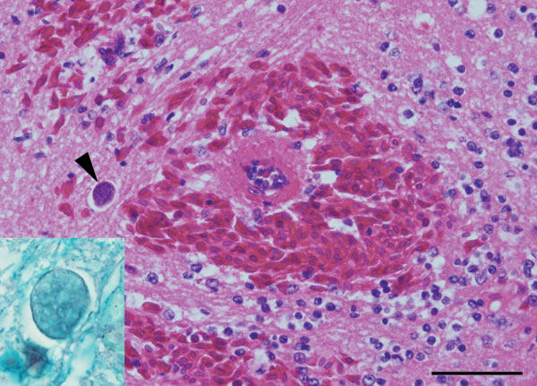 Acute severe encephalomalacia in the caudal brainstem of a captive Yellow-spotted Bell Frog from Sydney, Australia. This lesion was characterized by hemorrhage, vascular necrosis, and parasites consistent with Myxozoa (arrowhead) (hematoxylin and eosin stain; scale bar = 50 μm). Staining for axons confirmed intraaxonal location of the myxozoan parasites (inset, Holmes silver nitrate with Loxul Fast Blue stain).
