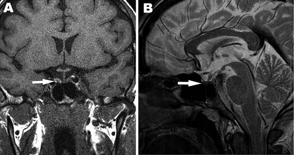 Magnetic resonance images showing hemorrhage of the pituitary gland and pituitary atrophy as indicated by arrows. A) T1-weighted coronal image shows high signal intensity on the right side of the adenohypophysis consistent with hemorrhage. B) T2-weighted sagittal image shows decreased pituitary gland height and heterogenous low signal intensity of the central adenohypophysis due to hemorrhagic infarction.