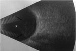 Thumbnail of Ocular ultrasound demonstrating hyperechoic, punctate opacities (arrows) within the vitreous chamber (X) of a patient with coccidioidomycosis, California, USA.