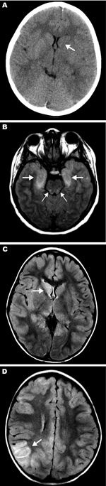 Thumbnail of Magnetic resonance images (MRIs) and computed tomography neuroradiographs showing lesions in brains of 3 children with eastern equine encephalitis A) Results of noncontrast computed tomography scan of the brain of patient 12 on hospital day 2; the neuroradiograph shows subtle hypoattenuation of the left caudate head (arrow) and diencephalic region. B) Axial fluid attenuated inversion recovery (FLAIR) image from brain MRI scan on patient 14 on hospital day 2; the image shows abnormal