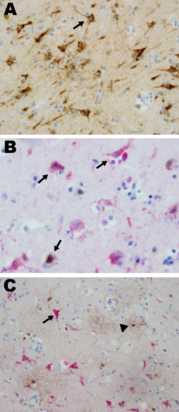 Eastern equine encephalitis virus (EEEV) colocalized with neurons in patient 12 in a study of children with eastern equine encephalitis (EEE), Massachusetts and New Hampshire, 1970–2010. A) Immunohistochemistry, using EEEV immune ascites, of the entorhinal temporal cortex, demonstrating EEEV-infected neurons (arrow) (magnification ×400). B) Dual immunohistochemistry with EEE immune ascites (red stain) and a mouse monoclonal anti–neuronal nuclei (NeuN) antibody (brown stain) demonstrates that EEE
