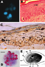 Thumbnail of Microsporidium detected in clinical specimens from a stem cell transplant patient who had undergone substantial immunosuppression. A) Calcofluor white–stained ascitic fluid (original magnification ×500). B) Hematoxylin and eosin–stained skin biopsy sample (original magnification ×400). The arrow indicates clusters of spores. C) Warthin-Starry–stained skin biopsy sample (original magnification ×400). The arrows indicate clusters of spores. D) Modified trichrome–stained material from 