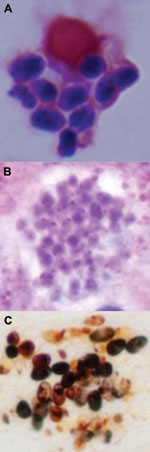 Thumbnail of Microsporidium detected in clinical specimens from a stem cell transplant patient who had undergone substantial immunosuppression. A) Gram-stained ascitic fluid (original magnification 1,000×). B) Hematoxylin and eosin–stained liver biopsy sample. C) Warthin-Starry–stained liver biopsy sample (original magnification 600×).