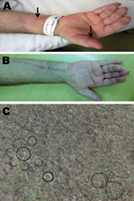 Thumbnail of A) Edema and erythema of the flexor surface of the hand of patient with paracoccidioidomycosis, carpal tunnel syndrome, and flexor tenosynovitis, Brazil. Note a fistulous pustulous nodule in the right thumb and forearm (arrows) and flexor contracture of the fourth finger. B) Flexor surface of the hand and forearm after surgery. C) Paracoccidioides brasiliensis was directly identified on the thumb secretion, sputum, and flexor tenosynovectomy specimen by using a 10% potassium hydroxi