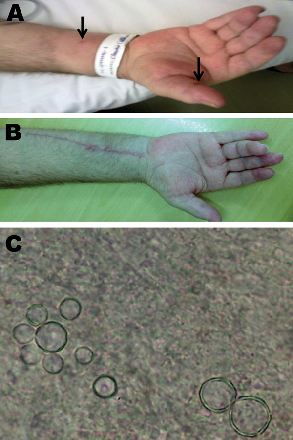A) Edema and erythema of the flexor surface of the hand of patient with paracoccidioidomycosis, carpal tunnel syndrome, and flexor tenosynovitis, Brazil. Note a fistulous pustulous nodule in the right thumb and forearm (arrows) and flexor contracture of the fourth finger. B) Flexor surface of the hand and forearm after surgery. C) Paracoccidioides brasiliensis was directly identified on the thumb secretion, sputum, and flexor tenosynovectomy specimen by using a 10% potassium hydroxide preparatio