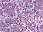 Thumbnail of Liver from a 62-year-old woman (lung transplant patient) showing acute necrosis of hepatocytes and minimal inflammation. Randomly distributed single-cell necrosis, as observed in this patient, is a histopathologic feature observed in lymphocytic choriomeningitis virus infection. Original magnification ×400.