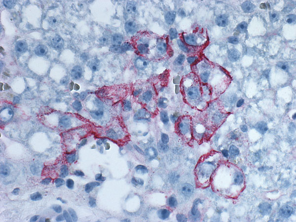 Immunohistochemical staining of lymphocytic choriomeningitis virus antigens in a biopsy specimen of the transplanted liver from a 60-year-old woman, which demonstrates abundant and predominantly perimembranous staining of hepatocytes. Original magnification ×200.