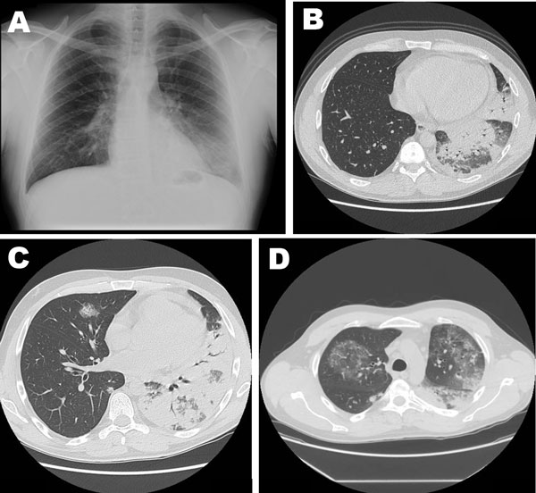 Imaging studies of 42-year-old man with severe pneumonia caused by Legionella pneumophila serogroup 11, showing lobar consolidation of the left lower lung lobe, with an air-bronchogram within the homogeneous airspace consolidation. Consensual mild pleural effusion was documented by a chest radiograph (A) and high-resolution computed tomography (B). A week after hospital admission, repeat high-resolution computerized tomography of the chest showed extensive and homogeneous consolidation of left u