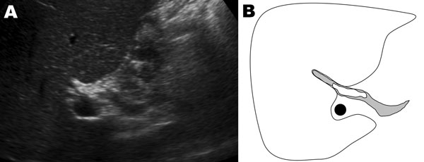 A) Ultrasound of the liver of a patient with Fasciola hepatica infection, the Netherlands. B) Drawing of A; depicted are the liver (white), the common bile duct (gray), and the portal vein (black). A fluke (white), measuring 2.5–3 cm long, is identified in the common bile duct.