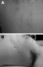 Thumbnail of Gnathostomiasis in a 37-year-old man, Brazil. A) Evanescent winding, linear, reddish lesions on the back in 2005. B) Deep migratory reddish nodules (arrows) on the lateral thorax, occurring in 2009 after treatment with albendazol for helmintic prophylaxis.