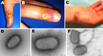Thumbnail of Orf virus infection in 5 persons who butchered or prepared lambs as part of a religious practice for Eid al-Adha (the Muslim Feast of Sacrifice), Marseille, France, 2011. Cutaneous lesions on hands of case-patient 3 (A, B) and case-patient 5 (C) are shown. Negative-staining electron microscopy of samples from case-patient 3 (D) and case-patient 5 (E, F) show ovoid particles (≈250 nm long, 150 nm wide) with a crisscross appearance; the size and appearance of these particles are highl