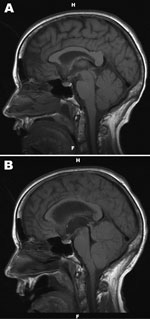 Thumbnail of A) Noncontrast, sagittal T1-weighted magnetic resonance image of the brain of a 67-year-old woman with suspected Powassan virus encephalitis, obtained 4 days after admission. Image is notable for nonspecific signal changes within the thalami, midbrain, cerebellar vermis, and both cerebellar hemispheres. B) Noncontrast, sagittal T1-weighted magnetic resonance image of the brain obtained 8 days after patient’s admission. Changes include marked interval progression of signal abnormalit