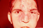 Thumbnail of Disfiguring infiltration of the nose, glabella, and forehead with clustered nodules in left interciliary region of boy with endemic syphilis, Iran, 2010.