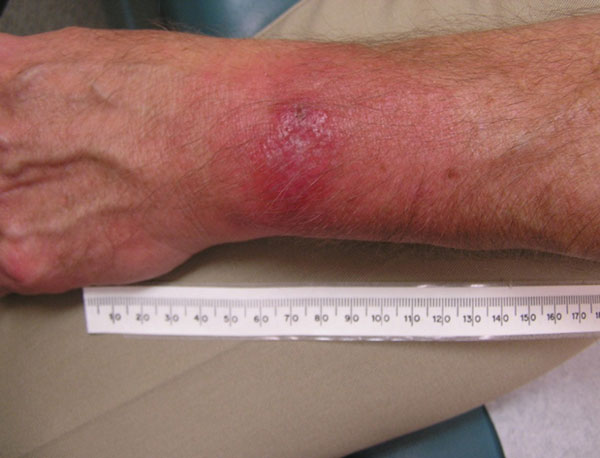 Atypical erythema migrans lesion on a patient with PCR-positive result for Borrelia burgdorferi infection. The rash was not considered typical because it lacked central clearing and peripheral erythema. The differential diagnosis included a contact dermatitis and arthropod bite. At the initial examination, this patient was seronegative for B. burgdorferi by 2-tiered criteria. Three weeks after therapy, the patient had positive results for ELISA and IgM Western blot and negative results for IgG W