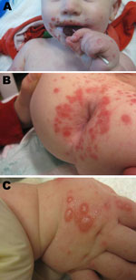 Thumbnail of Manifestations of hand, foot, and mouth disease in patients, Boston, Massachusetts, USA, 2012. Discrete superficial crusted erosions and vesicles symmetrically distributed in the perioral region (A), in the perianal region (B), and on the dorsum of the hands (C).