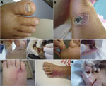 Thumbnail of Primary skin lesions in patients with invasive fusariosis in the hematology unit at University Hospital, Federal University of Rio de Janeiro, Rio de Janeiro, Brazil, 2000–2010. A) Onychomycosis; B) ulcer; C) intertrigus; D) intertrigus evolving to lymphangitis before dissemination. (First image in D is the same patient as the first image in C; second image in D is the same patient as the fourth image in C.) E) Necrosis in a lesion of intertrigus (evolution of the lesion shown in th
