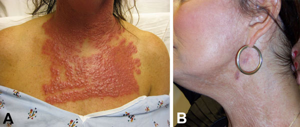 A) Neck and chest of a 53-year-old woman (case-patient 1) 14 days after fractionated CO2 laser resurfacing. B) Neck of the patient after 5 months of multidrug therapy and pulsed dye laser treatment. 