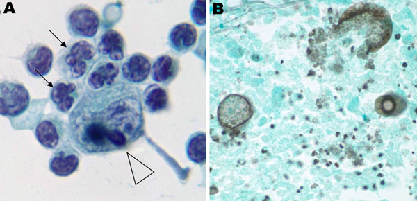 Test results of cerebrospinal fluid and brain tissue in HIV-positive man with signs and symptoms of meningitis, Atlanta, Georgia, USA, 2011. A) Atypical lymphocytes containing flower-shaped nuclei (arrows) and coarse chromocenters (arrowhead). Cerebrospinal fluid processed by Cytospin centrifuge (Thermo Electron Corp., Waltham, MA, USA) and prepared by Papanicolaou staining. Original magnification ×100. B) Gomori’s methenamine silver stain of sampled brain tissue showing multiple spherules and e