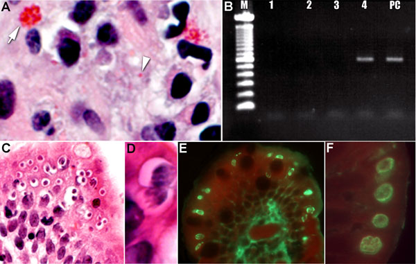 Tissue specimens from a kidney transplant recipient with concurrent parasitic infections after traveling to the Dominican Republic. A) Tissue section stained with Gram chromotrope. Note the apical location of a cluster of Enterocytozoon bieneusi spores at arrow (original magnification ×1,000) and single spore at arrowhead.; B) Agarose gel showing PCR amplification of E. bieneusi 18S rDNA in the scraped section, as in panel A (M, 100-bp ladder; lane 1, DNA lysate diluted 1:5; lane 2, 1:10, lane 3