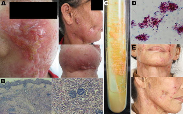 Cutaneous Mycobacterium shigaense infection in a 56-year-old Immunocompetent woman, China. A)  Plaques, scars with scabbing, nodules, and concave scars on the face and neck and papules and scarring on the submaxilla. B) Histopathologic results, showing hyperplastic epidermis and infiltration with lymphocytes, neutrophilic leukocytes, multinuclear giant cells, and epithelioid cells in the dermis. C) Samples streaked  on Löwenstein–Jensen medium at 32°C formed smooth, yolk yellow creamy colonies. 