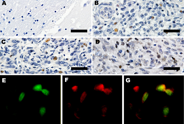 Expression of large T-antigen (LT-Ag) and p53 within a subset of tumors. A) Control, immunohistochemical analysis of frontal lobe of normal raccoon brain tissue. Astrocytes in this image and throughout the section were not immunoreactive for LT-Ag. Original magnification ×40. B, C) Immunohistochemical analysis for raccoon no. 2 (Rac2) and Rac3. LT-Ag is expressed within the nuclei of a subset of neoplastic astrocytes in 2 independent tumors. Original magnification ×40. D) Immunohistochemical ana