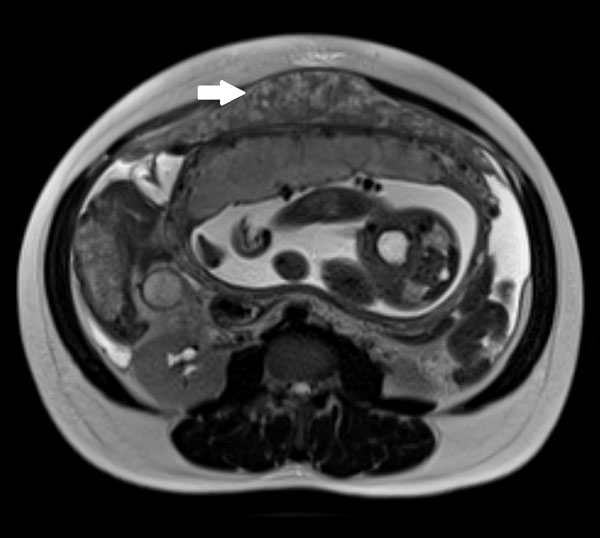 T2-weighted magnetic resonance imaging sequence of the pregnant woman’s abdomen demonstrating an omental mass of intermediate intensity (white arrow) anterior to the uterus.