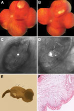 Thumbnail of Cysticercosis-like eye infection caused by the tapeworm Taenia martis in a woman. A) Fundus at the patient’s initial visit, before medical therapy. The cyst lies subretinally at the temporal upper branch vessels; adjacent intraretinal and subretinal bleeding and central subhyaloid bleeding can be seen. B) After 8 days of medical therapy, the cyst size had decreased markedly. The physis of the larva (A and B) is reminiscent of the armatetrathyridium (or fimbriocercus), a larval form 
