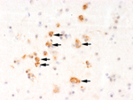 Thumbnail of Immunohistochemical staining with Usutu virus–specific antibody showing virus antigen in the brain of a blackbird that died during an Usutu virus outbreak in Italy, 1996. Numerous neurons show characteristic, frequently coarsely granular cytoplasmic labeling (arrows). Original magnification ×390. 