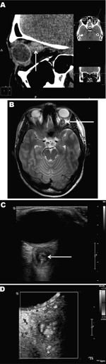 Thumbnail of Retroocular nodule of a Dirofilaria repens worm detected in a 20-year-old woman, Rostov-na-Donu, Russia. The cyst (arrows) is shown by computed tomography scan (A) and magnetic resonance imaging (B). Ultrasonography images (C) show a worm-like structure inside the cyst (arrow), and color Doppler imaging (D) shows marginal vascularization of the lesion).