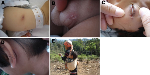 Eschars in different body areas of children with scrub typhus (A–D) and a child carried on his mother’s back during work (E), Ban Pongyeang, Thailand.