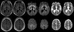 Thumbnail of Maps showing axial fluid attenuated inversion recovery (FLAIR), diffusion-weighted imaging (DWI), and apparent diffusion coefficient (ADC) at the level of the basal nuclei (top row) and dorsal frontoparietal cortex (bottom row) of the brain of a 33.8-year-old man with agenesis of the corpus callosum, schizencephaly, and heterotopia. Note the symmetrical DWI signal hyperintensities in the striatum and dorsomedial part of the thalami. In addition, DWI signal hyperintensities occurred 