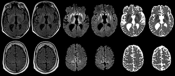 Maps showing axial fluid attenuated inversion recovery (FLAIR), diffusion-weighted imaging (DWI), and apparent diffusion coefficient (ADC) at the level of the basal nuclei (top row) and dorsal frontoparietal cortex (bottom row) of the brain of a 33.8-year-old man with agenesis of the corpus callosum, schizencephaly, and heterotopia. Note the symmetrical DWI signal hyperintensities in the striatum and dorsomedial part of the thalami. In addition, DWI signal hyperintensities occurred in the cingul