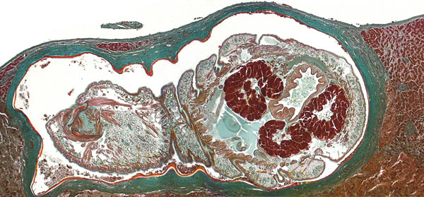 Oblique cross-section of liver of a patient (immigrant) from Togo, showing a well-preserved Armillifer armillatus nymph in a subcapsular location. The annulated parasite is encapsulated by its shed cuticle (exuvia) and dense fibrosis. Consistent with the viable type of a pentastomid lesion (3), no inflammatory infiltrate is visible. This image also shows internal structures of the pentastome, such as prominent bunches of acidophilic glands surrounding the intestine (Masson’s trichrome stain, ori