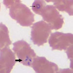 Thumbnail of Wright-stained blood smear for patient 1 with babeosis on day 1 of hospitalization, eastern Pennsylvania, USA, showing an intraerythrocytic trophozoite of Babesia microti in a ring form (thin arrow) and a tetrad arranged in a cross-like pattern (thick arrow). Original magnification ×1,000.