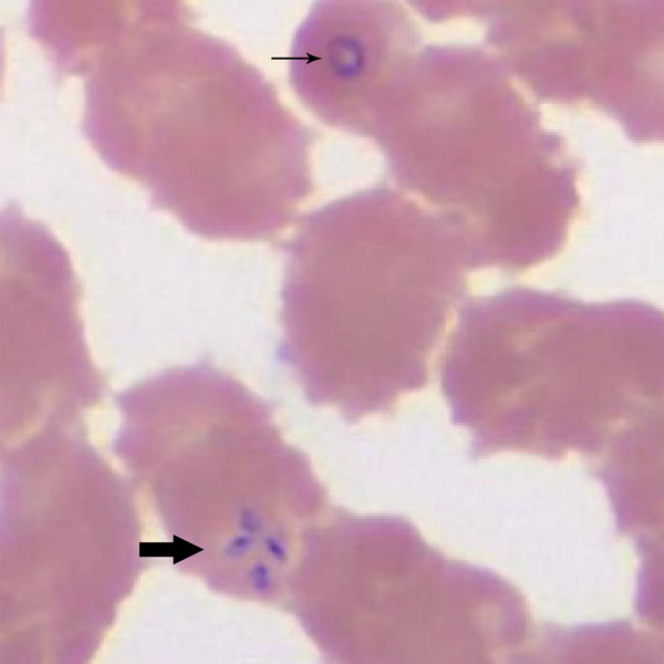 Wright-stained blood smear for patient 1 with babeosis on day 1 of hospitalization, eastern Pennsylvania, USA, showing an intraerythrocytic trophozoite of Babesia microti in a ring form (thin arrow) and a tetrad arranged in a cross-like pattern (thick arrow). Original magnification ×1,000.
