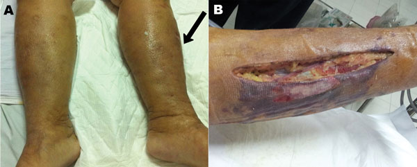 Shewanella haliotis severe soft tissue infection of woman in Thailand, 2012. The patient sought treatment for painful erythematous swelling of the left leg. A) Arrow indicates affected area. B) Postsurgical fasciotomy wound with necrotic tissue.